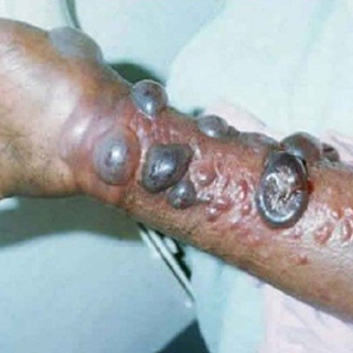 Tphcm: Cảnh Báo Nguy Cơ Xâm Nhập Bệnh Marburg Gây Tử Vong Rất Cao